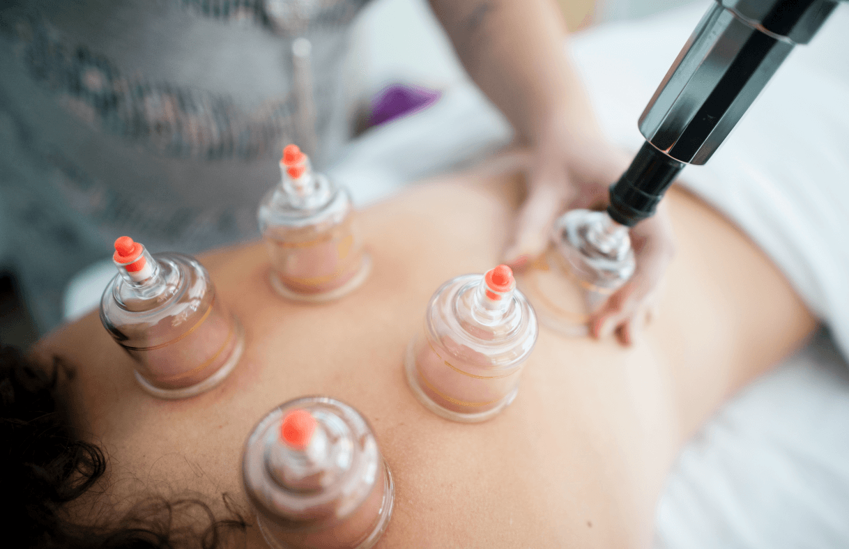 Image for Myofascial Cupping Treatment